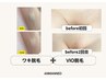 リニューアルオープンキャンペーン【ワキ脱毛&VIO脱毛セット】6,900円
