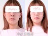 《当日予約限定》加工も整形も不要★中顔面短縮/リフトUP/頭蓋骨小顔矯正70分