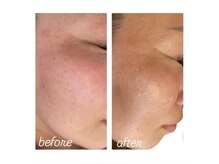 イロドリ(IRODORI)/REVIハーブピーリング