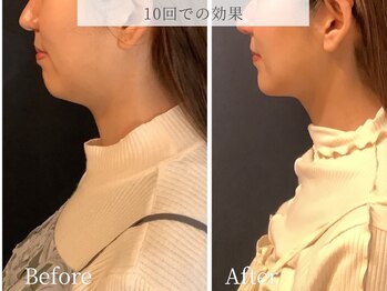 ブリリオ 池袋店(Brillio)/1回での効果