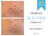 【人気No.1】何度も繰り返す大人ニキビでお悩みの方へ|REVIハーブピーリング