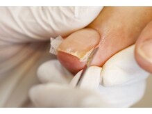 爪切り屋 足楽 日本橋三越前店/陥入予防