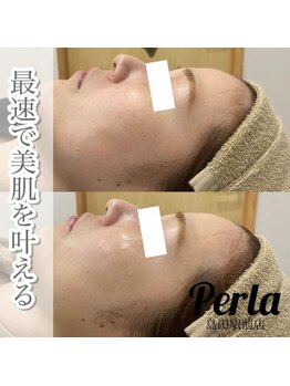 ぺルラ 島田駅前店(Perla)/光フェイシャル