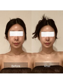 アラマンダ(Allamanda)/首肩デコルテBeforeAfter