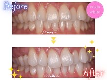 エクシアホワイトニング 原宿店/ホワイトニングビフォーアフター