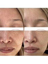 エヌミー(N me)/３回施術ビフォーアフター