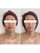 エミニー バイ エルズ(Eminy by L★s)/30代　小顔コルギ　1回