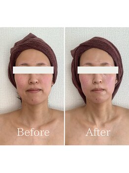 エミニー バイ エルズ(Eminy by L★s)/30代 小顔コルギ 1回