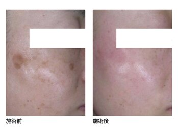 オーシャンブルー 長崎店(OCEAN BLUE)/美白・シミケア