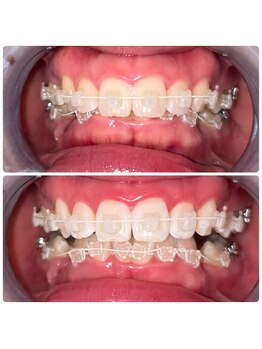 コナホワイトニング 神保町/矯正ホワイトニング