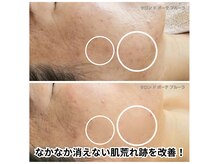 サロン ド ボーテ プルーラ(Salon de beaute PLURA)の雰囲気（小山では希少のソフトダーマで肌荒れ跡を改善！）
