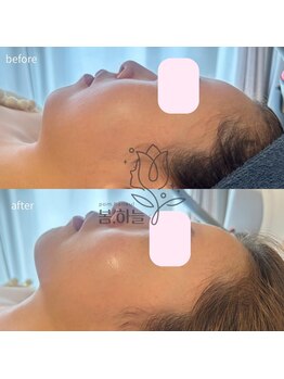 韓国肌管理室pom.haneul【ポムハヌル】LDM/インモード/ララピール/プラピール福岡天神/韓国肌管理室