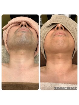 ラ ボーテ(La Beaute)の写真/【駅徒歩30秒／都度払い可！】ハイパワー最新脱毛機導入★メンズ脱毛を知り尽くしたスタッフによる施術◎