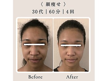 インディバホリトウキョウ(INDIBA HORI TOKYO)の写真/たるみは引き上げるだけじゃない。土台から整えるINDIBA HORIのフェイシャルインディバ