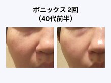 アユアラングレース/40歳前半・1回/頬の毛穴・法令線