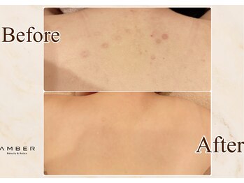 アンバー 恵比寿(AMBER)/ダウンタイム有ハーブピーリング