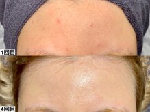 アンドミー 西宮北口店(&me)/ハーブピーリング【ニキビケア】