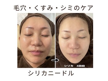 リリアン(lirien)/毛穴/毛穴ケア/毛穴洗浄/駒込