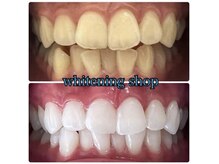 ホワイトアイ 名護(WHITE EYE)の雰囲気(ツルツルの白い歯へ!痛みを感じにくい・飲食の制限なし♪)