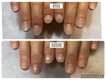 アンドネイル 海老名(&nail)/初回と3回目比べてみました