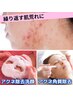 ≪肌荒れ≫毛穴洗浄+医療提携サロンのニキビケア+LEDライト/施術90分¥9,800→