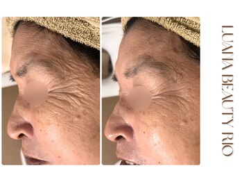 リオ(RIO)/初回で目元のシワがここまで変化