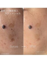 プリンセスローズ 焼津店(Princess Rose)/光フェイシャル