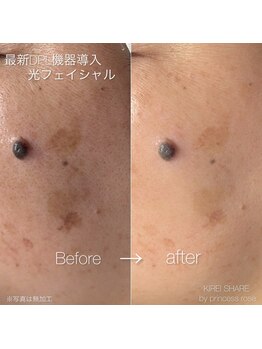 プリンセスローズ 焼津店(Princess Rose)/光フェイシャル