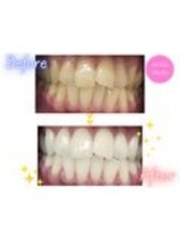 エクシアホワイトニング 原宿店/ホワイトニングビフォーアフター