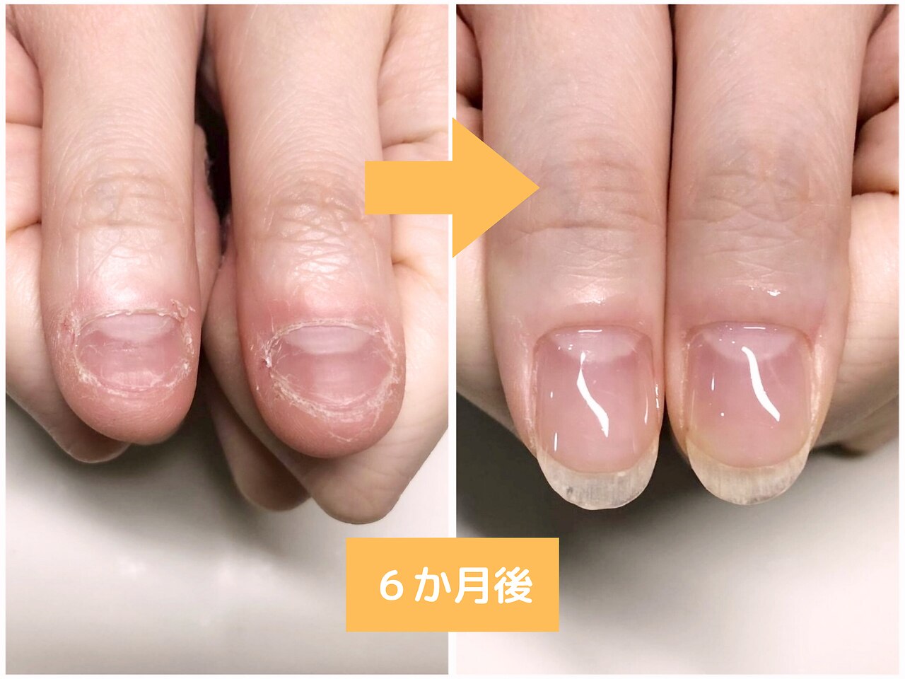 【爪育成・初回お試し】爪の形を変えたい！縦長の美爪へ☆　￥16500→