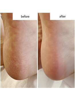 ケアプラス(care plus)/足裏角質ケア