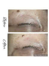 フリージア(Beauty Salon Freesia )/美肌菌活ピール　1回目　