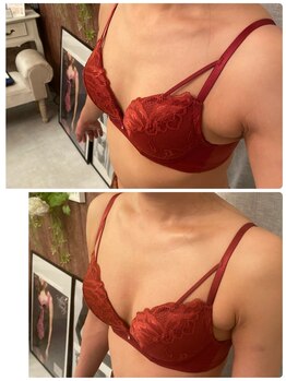 スマイルクルー(SmileClue)/初回ビフォーアフター症例