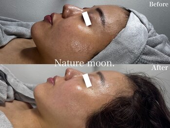 ナチュールムーン(Nature moon.)/ハーブピーリング