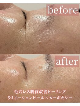 アディクトウラ(Addict'ula)/ラミネーションピール