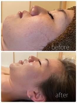 private salon KANASAの写真/肌荒れ経験を持つオーナーが寄り添うハーブピーリングで極上の癒やしを体験♪