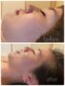 private salon KANASAの写真/肌荒れ経験を持つオーナーが寄り添うハーブピーリングで極上の癒やしを体験♪