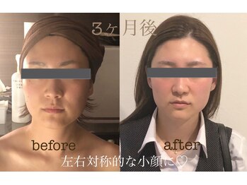 ラ フルール(La Fleur)/小顔矯正コルギ　before→after