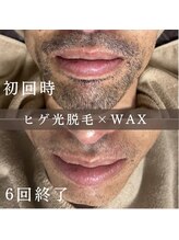 エピナ 横浜店(Epina)/before&after★メンズ/ひげ脱毛