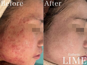 ライム 武蔵小杉(LIME)/ハーブピーリング｜ニキビケア