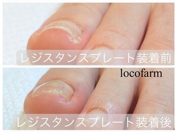 ロコ ファーム(loco farm)/巻き爪改善ケア