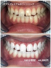 ホワイトニングビューティー 行橋店/続けた93%の方が目標の白さ達成