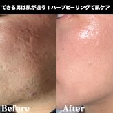 ハーブピーリングHY