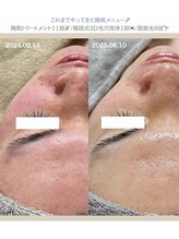 クレヴィー(Creviy)/陶肌トリートメント7回