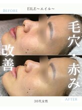 エイル(EILE)/症例