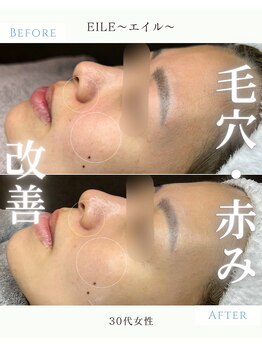 エイル(EILE)/症例