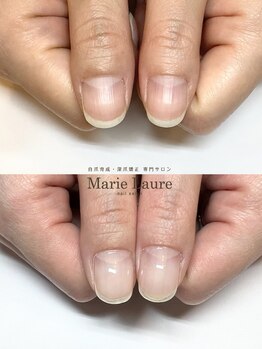マリーロール 梅田店(Marie Laure)/自爪育成/深爪矯正/ネイルケア