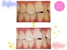 エクシアホワイトニング 原宿店/ホワイトニングビフォーアフター