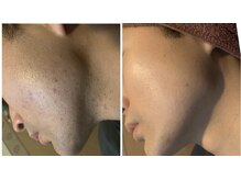 ガムラン(Gamelan)/メンズ脱毛