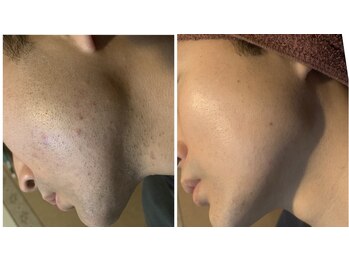 ガムラン(Gamelan)/メンズ脱毛